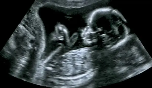 Echo van een baby